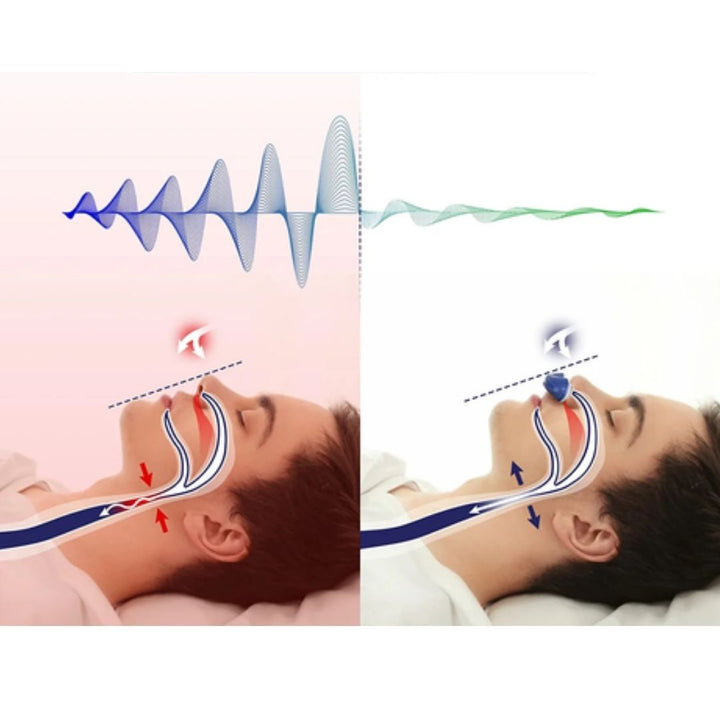 Illustration von Schnarchen: Vergleich der Atemwege bei normaler Atmung und Schnarchen, zeigt Luftstrom und Vibrationen. Schlafapnoe, Atemweg, Gesundheit.